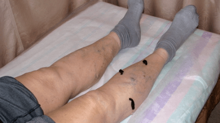 visszér kezelése piócákkal