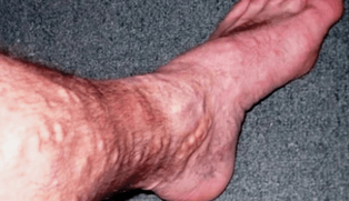 a varikózis oka a férfiak lábán