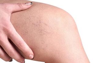 a varikózus vénák fejlődési szakaszai