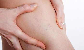 okai a visszerek kialakulásának a lábakon