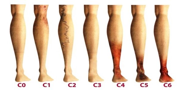 a varikózis kialakulásának szakaszai a lábakon