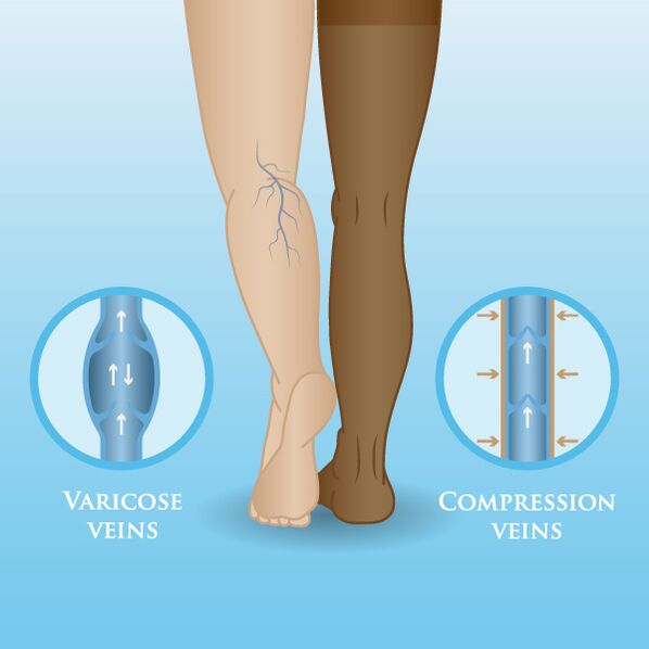 A kompressziós ruhák hatása a visszerekre a lábakon