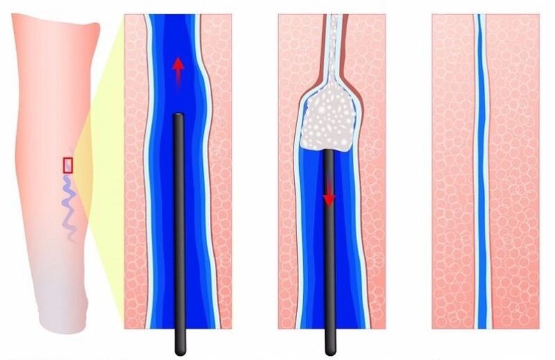 szkleroterápia a lábak visszér kezelésére férfiaknál