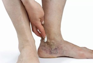 Lehetséges szövődmények a lábvénás eltávolító műtét után és megelőzésük - Embólia 